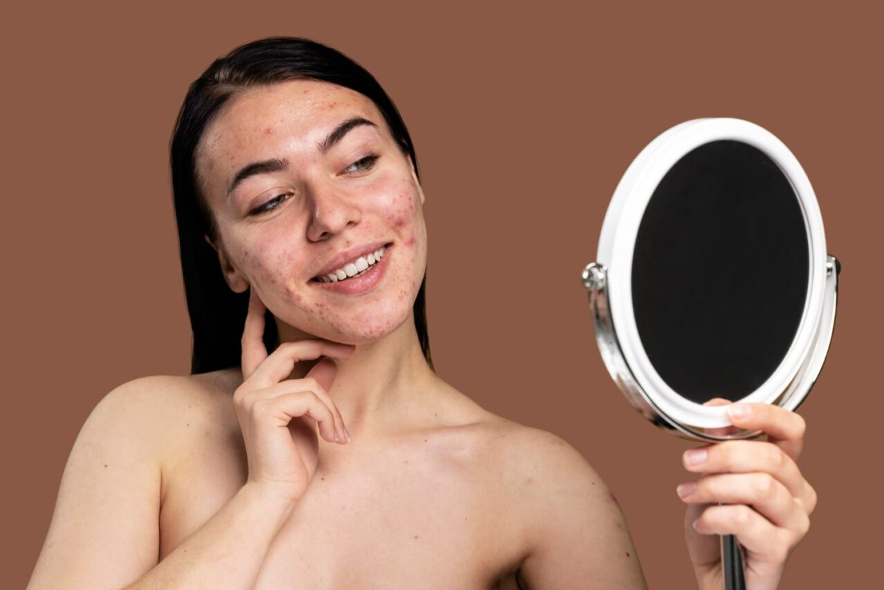 mulher com acne no rosto olhando no espelho para ilustrar texto sobre o que pode piorar a acne